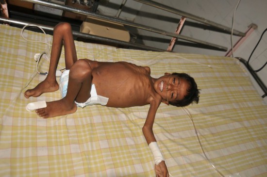 Death of a child by malnutrition in the adoption village of Chief Minister Devendra Fadnavis