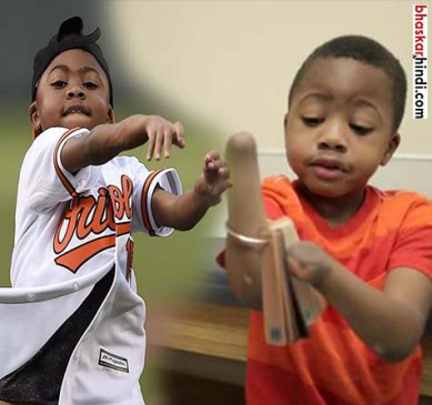 The childs first hand transplant successful