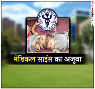 Surgery done in AIIMS has been successful in separating twin babies