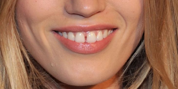 Gap Between teeth, Ever Wondered If the Gap Between Your Teeth