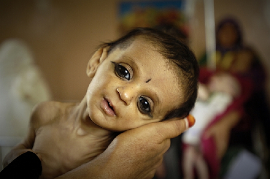 No nutrition diet - how far will malnutrition, 31 thousand are malnourished