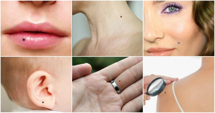 Mole : mole on these parts of the body can be auspicious for you