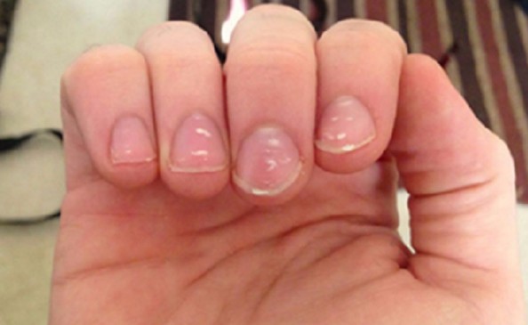 white marks on nails tells about the personality of a person
