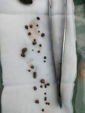 Patient treated successfully having 50 stones in kidney