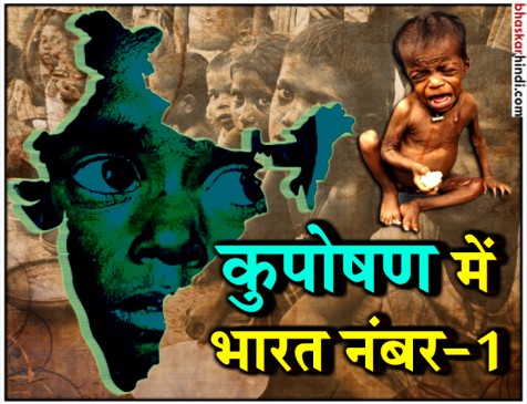 दुनिया के सबसे ज्यादा कुपोषित बच्चे भारत में, पाकिस्तान से भी चार गुना ज्यादा