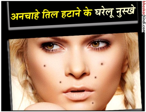 चेहरे के अनचाहे तिलों से पाएं छुटकारा, इन घरेलू नुस्खों का करें इस्तेमाल