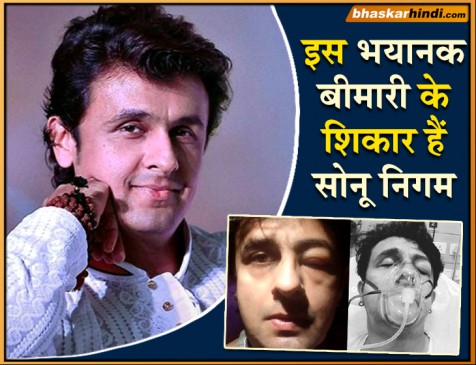 इस बीमारी का शिकार हुए सोनू, सोशल मीडिया पर शेयर की फोटो