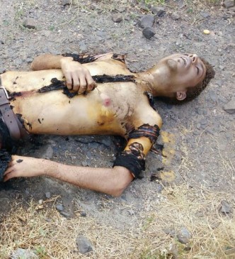 A young man badly burned  with high voltage current from OHE wire