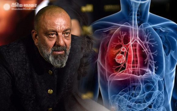 Lung Cancer: एक्टर संजय दत्त को फेफड़ों का केंसर, इलाज के लिए अमेरिका रवाना होंगे