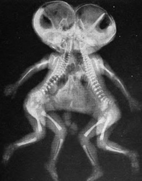 For the first time in KGMU, the separated children were separated