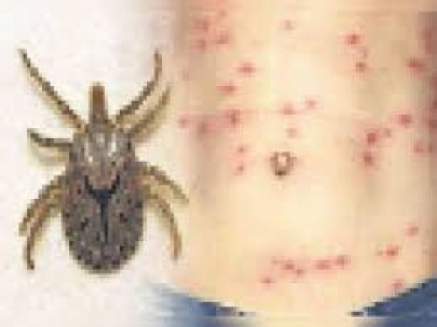 Two patients of scrub typhus found in Nagpur