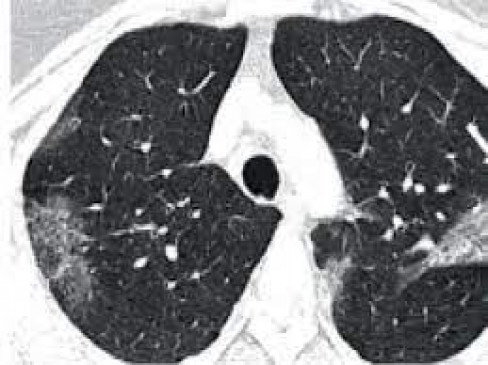 Mucar mycosis disease farmers most at risk