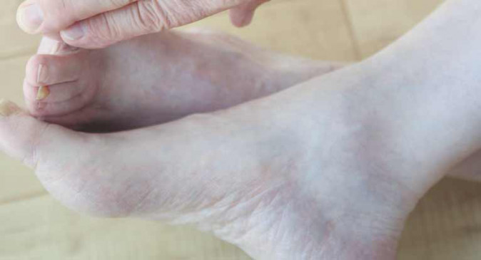 Gangrene due to blood clot formation after corona