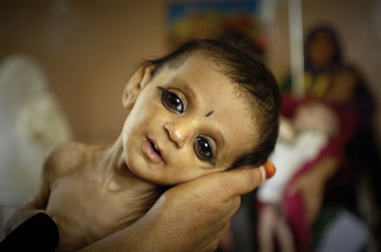 Malnutrition increased in Nagpur district during the Corona period, 548 children malnourished