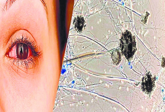 Mucor mycosis patient not found in Nagpur