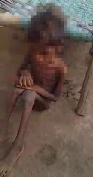 Governments schemes fail, very seriously malnourished girl found in Chitrakoot, condition critical