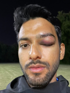 Former India Under-19 player Unmukt Chand sustained an eye injury while playing cricket.