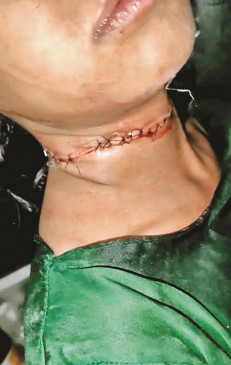 Stop those who use bloody manja, girls throat slit - life saved