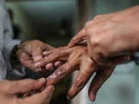Number of lepers increased in Maharashtra after Corona crisis