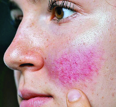 Skin patient is making desire to look fair, dangerous chemical is used Skin patient is making desire to look fair, dangerous chemical is used